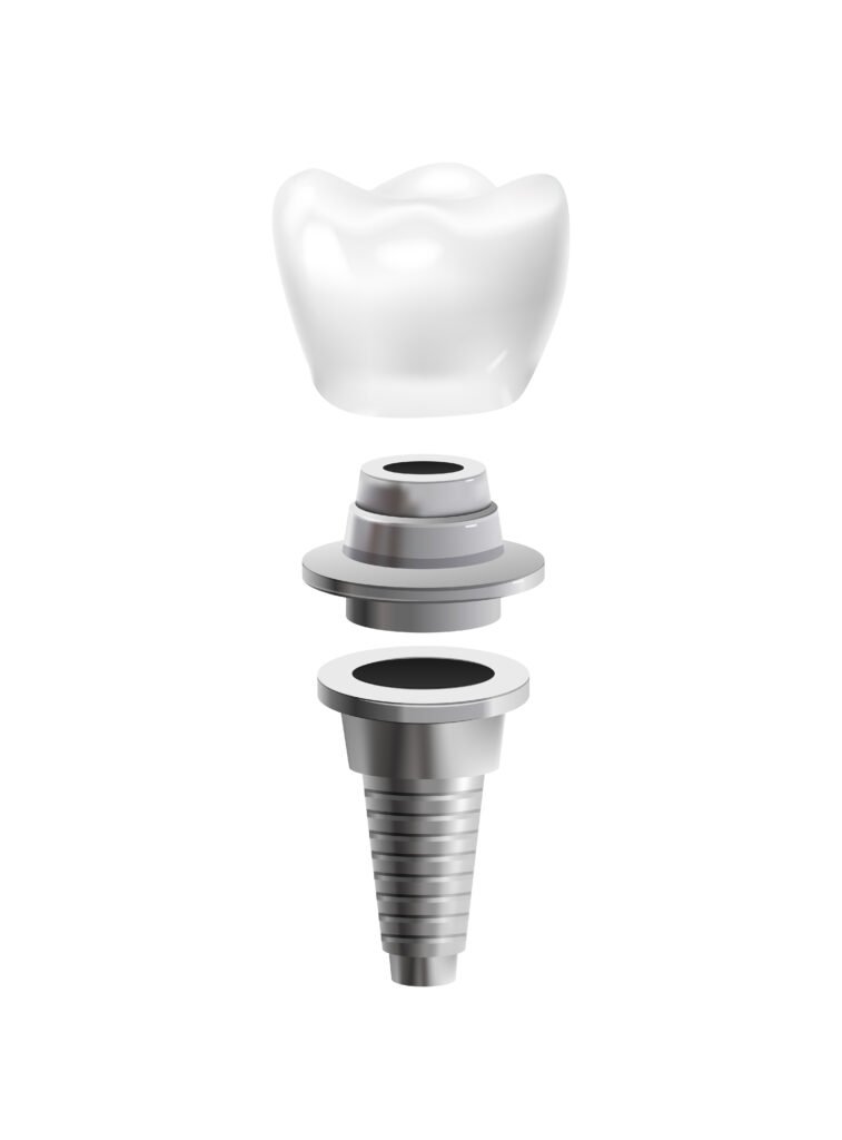 Gebze implant tedavisi