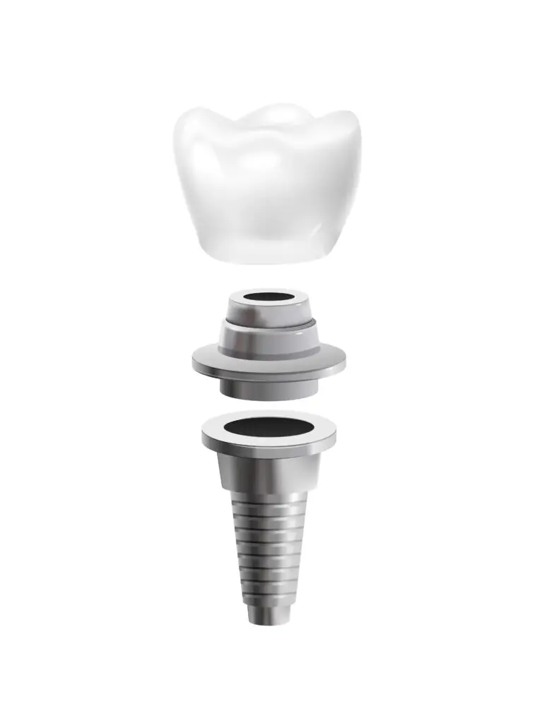 Gebze implant tedavisi