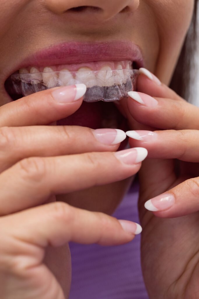 Gebze Şeffaf Plak Invisalign Tedavisi