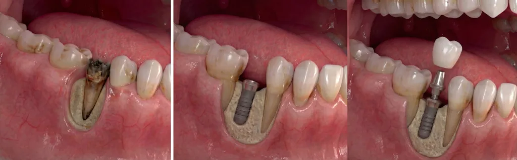 Gebze Kocaeli Aynı Gün Diş Immediate Tedavisi